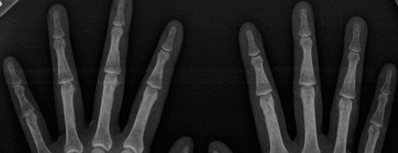 Subperiostāla kaulu resorpcija parasti notiek 2,3 pirksta mediālā un proksimālā falangas kaulu