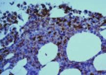 attēls. Vidēji un lieli atipiskie plazmocīti (mielomas šūnas) ar plazmoblastisku diferenciāciju kaulu smadzeņu trepānbiopsijā.
