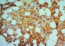 7. attēls. Kaulu smadzeņu intersticiāla un fokāla mielomas šūnu infiltrācija, kuras ekspresē aberanto CD56 marķieri plazmolemmā.