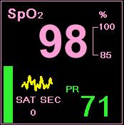 SpO2 dati, kas tiek attēloti Capnostream monitorā 2. Nellcor SpO 2 sensoru pievienojiet pacientam, kā aprakstīts tā lietošanas norādījumos, izmantojot Nellcor SpO 2 sensora pagarinājuma kabeli. 3.