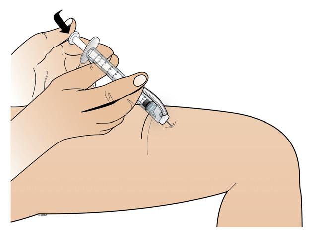 adatu no ādas, uzmanoties, lai saglabātu tādu pašu leņķi, kā iedurot; injekcijas vietā ir iespējama neliela asiņošana.