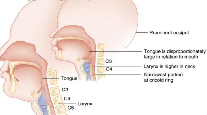 Zīdaiņu anatomiskās atšķirības Relatīvi liela mēle, kas aizpilda mutes dobumu Bedrītes vaigos zīšanas laikā Relatīvi mazs