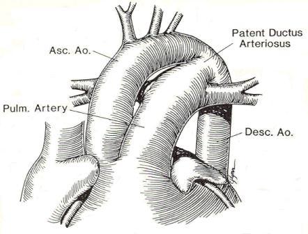 Normāla struktūra auglim savienojums starp kreiso plaušu artēriju