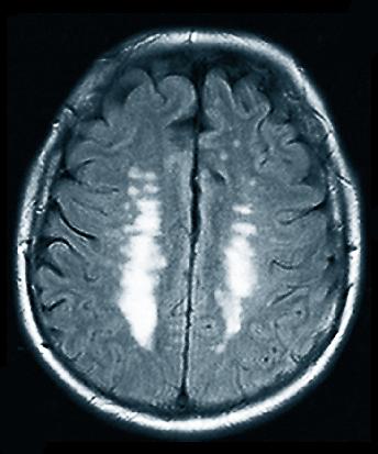 (asinsvadu savijumi) FLAIR-uzvērtā MRI "baltās