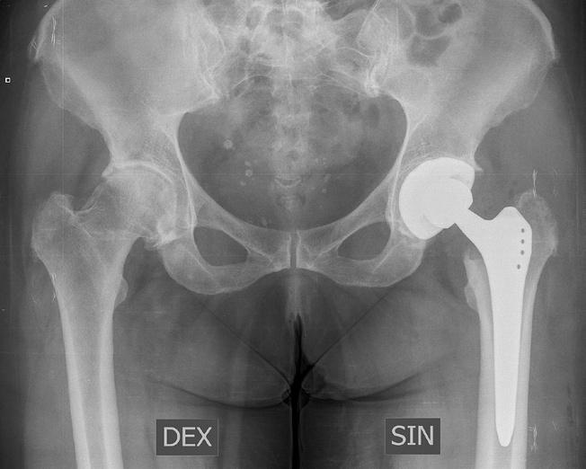 Sergejs Zadorožnijs 1. attēls. Iegurņa pārskata rentgenogramma pacientam pēc gūžas locītavas totālās endoprotezēšanas. Pa kreisi gūžas locītavas anatomiskas struktūras neprotezētajā pusē.