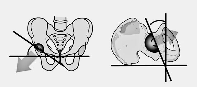Inklinācija Acetabulārā bedre Augšstilba kaula kakliņš Augšstilba kauls Acetabulārais komponents Galviņa Kājiņa Anteversija iemeslu.