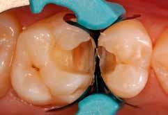 Pateicoties izcilai ķīmiskai adhēzijai pat ar iepriekš neapstrādātu dentīnu, ideāli piemērots MIH skartu zobu atjaunošanai Pieejams EQUIA Forte HT Fil: kapsulas EQUIA Forte Coat: