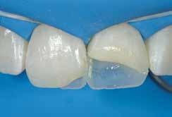 dabisko zobu novecošanos, koncepciju Pateicoties īpaši smalkajām daļiņām, ko izmanto emaljas toņos, restaurācijām ir ļoti noturīgs virsmas spīdums