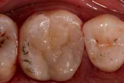 Tas spēj imitēt gan dentīnu, gan dentīna-emaljas savienojuma vietu, nodrošinot dentīna elasticitāti un izturību un