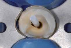 GRADIA CORE Duāli cietējošs rentgenkontrastains kompozītmateriāls zoba stumbra atjaunošanai un tapas cementēšanai Pilna sistēma estētiskai