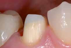 Turklāt sacietējuša materiāla cietība ir tāda pati kā dentīnam, tādēļ to, neradot rievas uz robežas starp zoba struktūru un stumbra