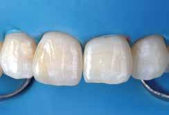 Pieejams Pudelīte Kapsula "Prognozējama adhēzija ar dentāliem substrātiem ilgu laiku ir bijis apgrūtinošs un tehniski sensitīvs uzdevums.