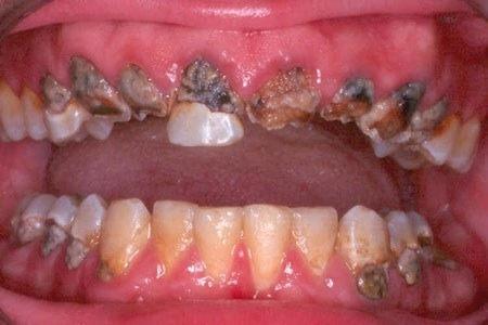Neskaidra anamnēze, vairāki zobi ar sliktu/vidēji sliktu