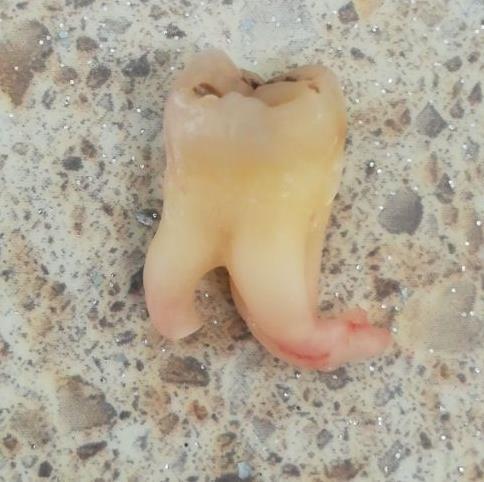 Paliekoša zoba sakne/daļa alveolā Agrīna/vēlīna komplikācija Kāpēc: Nepareiza zoba/saknes izvērtēšana pirms ekstrakcijas (RTG!