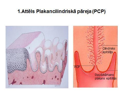 Plakanā - cilindriskā epitēlija pāreja (PCP) 1-daudzkārtaini plakanais epitēlijs, 2-PCP, 3-cilindriskais epitēlijs Plakanā-cilindriskā epitēlija pāreja PCP, attiecībā pret dzemdes kakla ārējo muti
