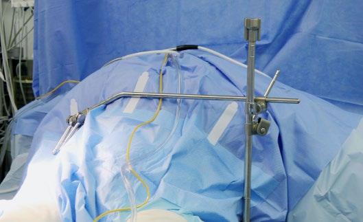 Step 1: Attach Elite to Bed Place Elite Rail Clamp onto the table rail over the sterile drape on the side opposite of the surgeon, and at the