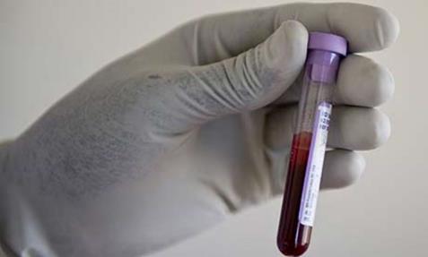 1. Laboratoriskie izmeklējumi un eksprestesti Primārā HIV diagnostika Tiek izmantoti: testi