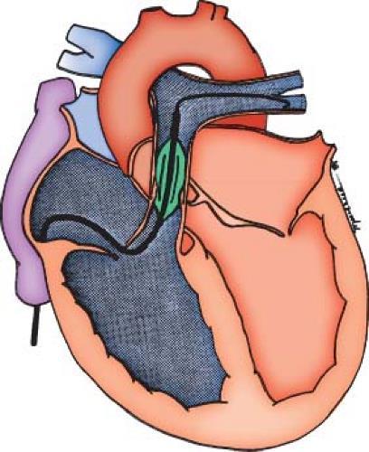 izmantota plaušu artērijas vārstules saaugušo viru šķelšanai.