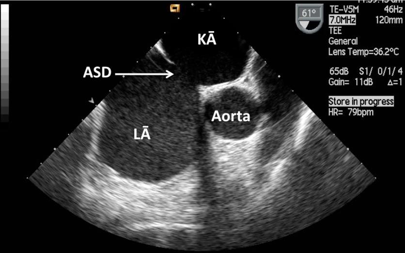 2.2.6.1. attēls. Otrā tipa ASD vizualizācija transezofageālajā ehokardiogrāfijā ASD- ātriju starpsienas defekts, KĀ- kreisais ātrijs, LĀ- labais ātrijs. Attēls no Latvijas Kardioloģijas centra arhīva.