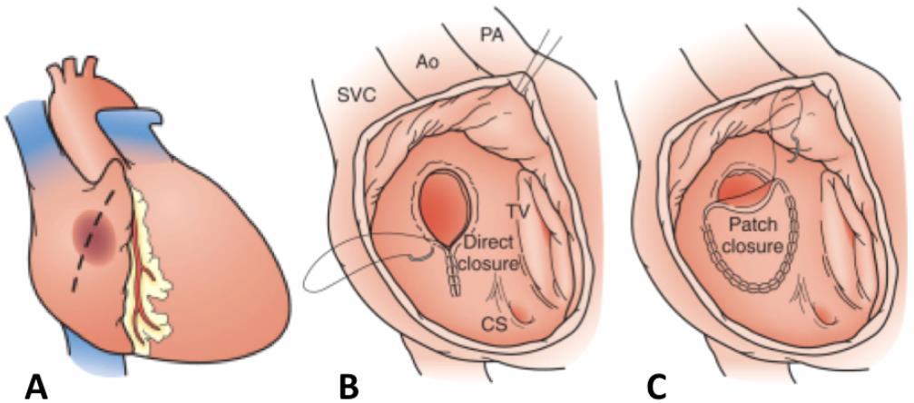 2.3.2.1. attēls. Ķirurģiska ASD slēgšana Ao - aorta, CS - koronārais sīnuss (no angļu val. coronary sinus), PA - plaušu artērija, SVC - augšējā dobā vēna (no angļu val.