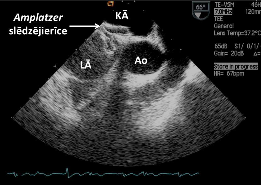 2.3.4.2. attēls. Amplatzer slēdzējierīce transezofageālajā ehokardiogrāfijā Ao - ascentējošā aorta, KĀ - kreisais ātrijs, LĀ - labais ātrijs.
