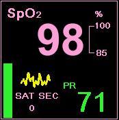 Capnostream 20p monitorā rādītie SpO2 dati Capnostream 20p monitorā rādītie SpO2 dati Capnostream 20p monitora ekrānā Home (Sākums) tiek attēloti reāllaika SpO 2 dati.