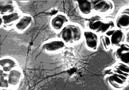 gamokvlevebi Catarebuli iyo 34 avadmyofze. Ffazakontrastuli mikroskopit Seswavlil iqna Trombocitograma da Trombocitebis adheziisa da agregaciis unari.