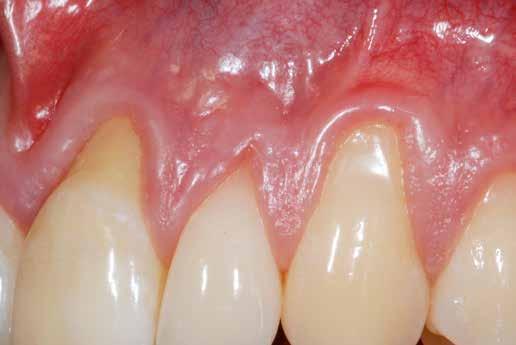 Bindegewebstransplantat wurde am Zahnhals fixiert.
