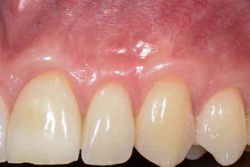 10: Das klinische Bild 10 Jahre nach der Behandlung verdeutlicht die Stabilität der Ergebnisse. Abb. 11: Präoperative Situation eines Patienten mit freiliegenden Kronenrändern an Zähnen 11 und 21.