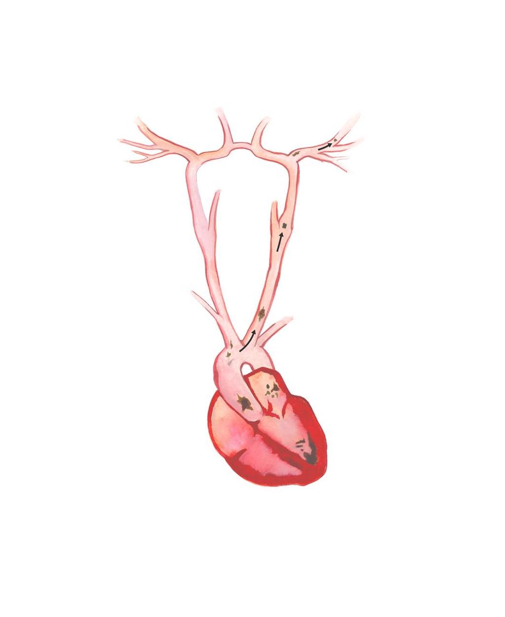 Smadzeņu artērijas Miega artērija Embols no sirds Aortas loks Embols no sirds Trombi un emboli sirds