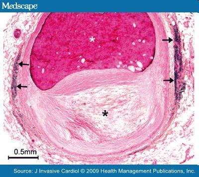 Aterosklerotiskā plāksne Koronārās artērijas segments LAD vidējā daļā 49