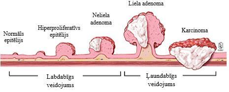 Parasti adenokarcinomu raksturo dziedzeru veidošanās, kas attīstās no kolorektālās gļotādas epitēlija šūnām. 1.1.5.